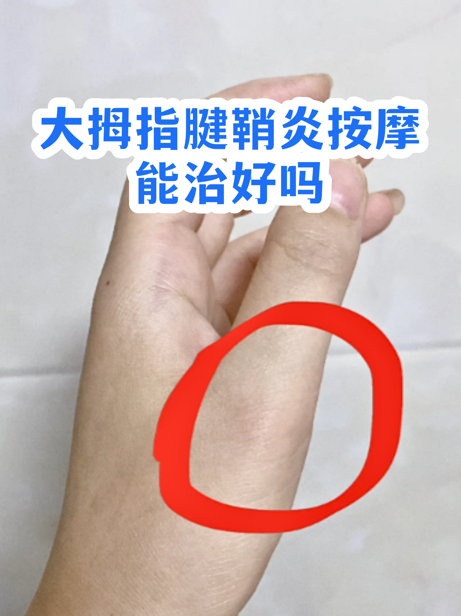 手指腱鞘炎怎么治(拇指腱鞘炎怎样治疗)