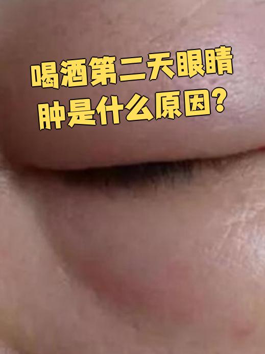 酒精入眼睛怎么办(酒精进入眼睛如何处理)