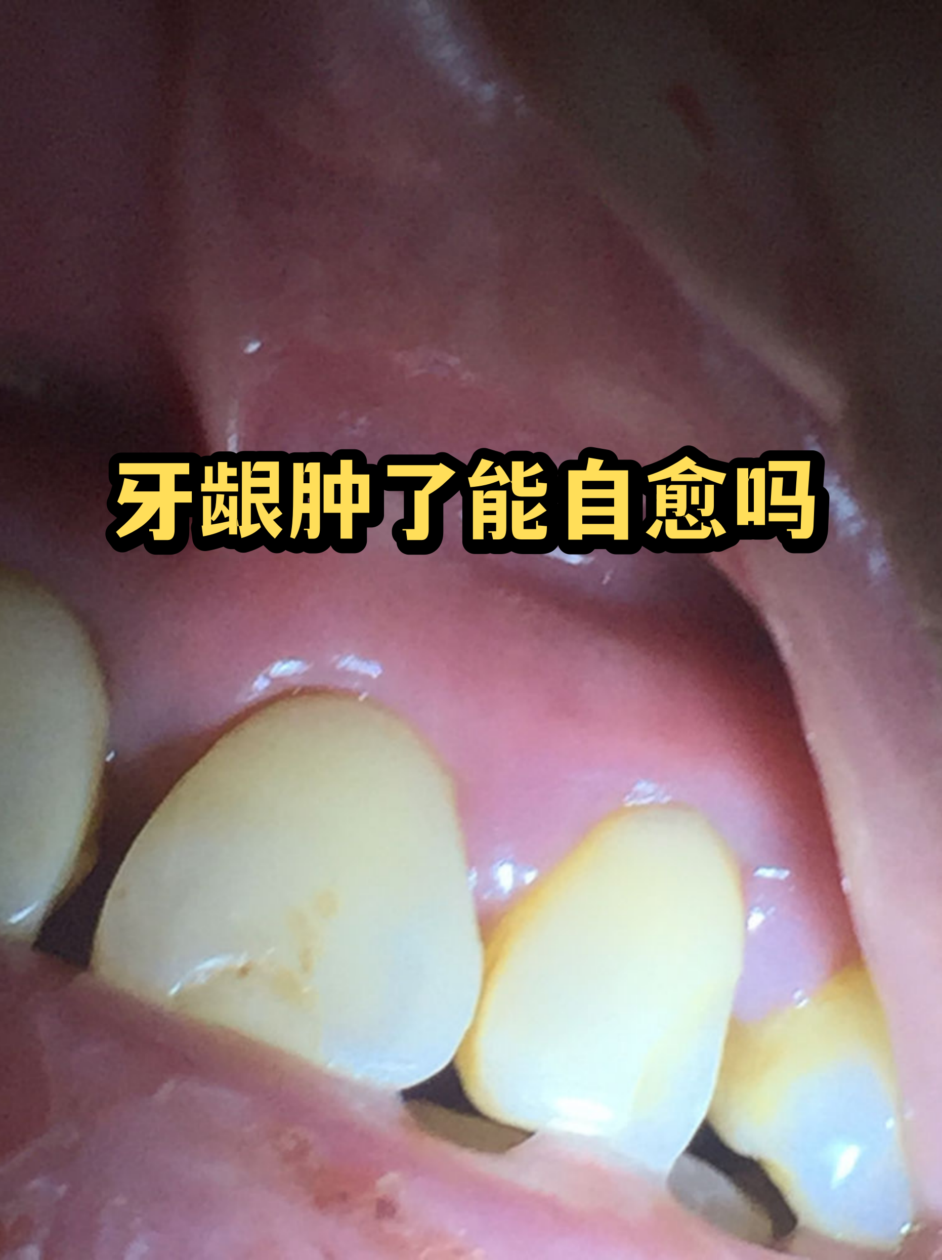 孕妇牙龈肿痛会自愈吗(孕妇牙疼的实在受不了怎么办)