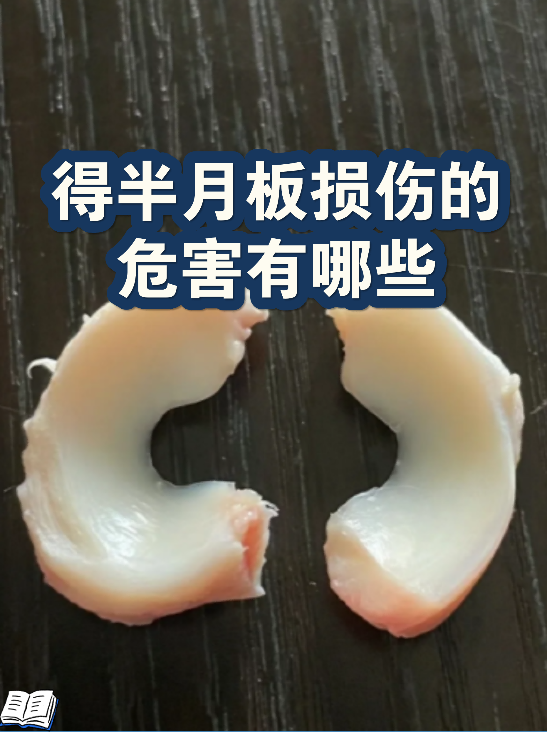 半月板损伤一辈子完蛋了(半月板损伤后能够再次愈合吗) 半月板损伤一辈子完蛋了(半月板损伤后能够再次愈合吗)